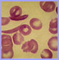 microscopic photo of sickle-shaped cells